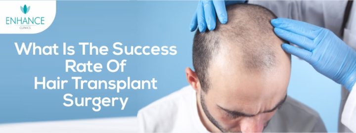 6 Common Benefits Of Hair Transplant Surgery