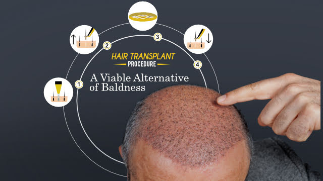 Home  QHT Clinic  Hair Transplant Service India